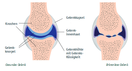 Gesundes und erkranktes Pferdegelenk